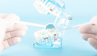 Sözlü sağlık kavramı diş modeli ile diş hesabı.