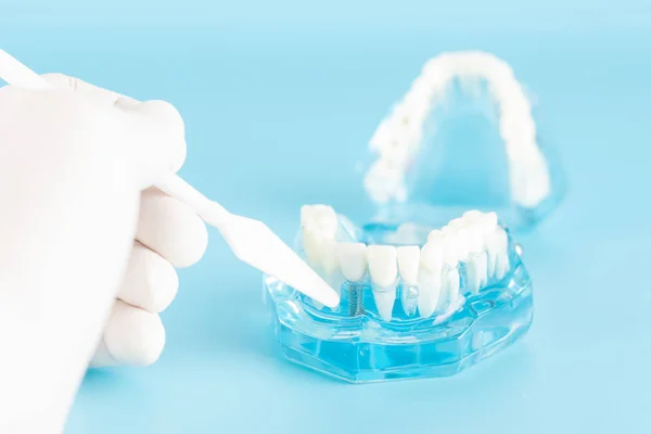 Revisión Implantes Dentales Concepto Atención Salud Bucal — Foto de Stock