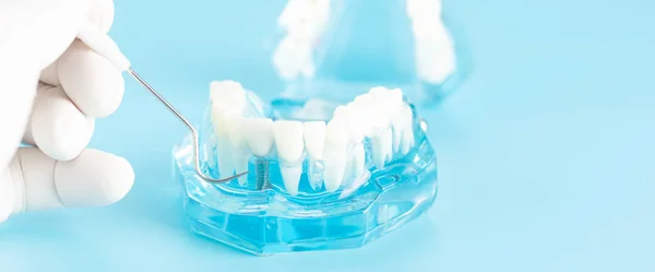 Dental Implant Check Met Tandheelkundige Model Mondelinge Gezondheidszorg Concept — Stockfoto