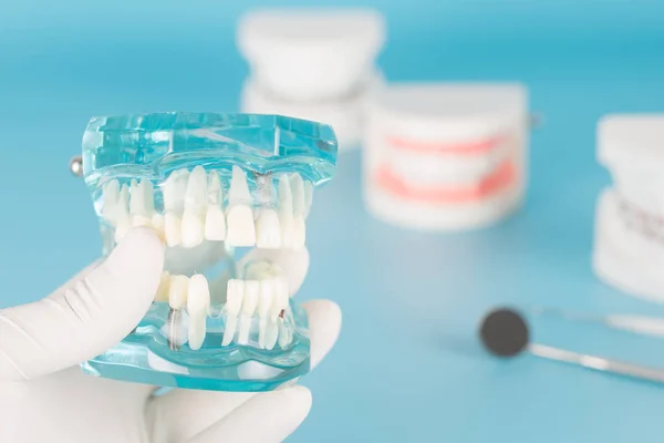 Missing tooth on dental model in dental care concept.