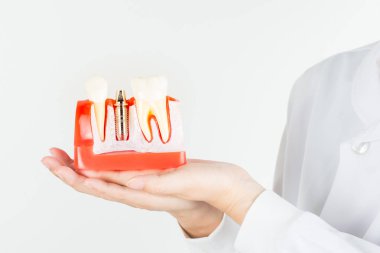 Dental implant dişeti içinde diş hekimi gösterisi modeli.