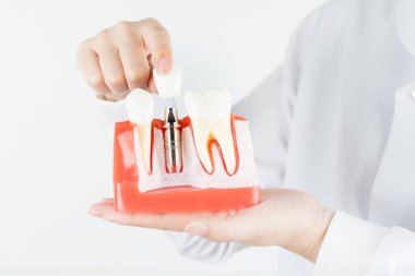 Dental implant dişeti içinde diş hekimi gösterisi modeli.