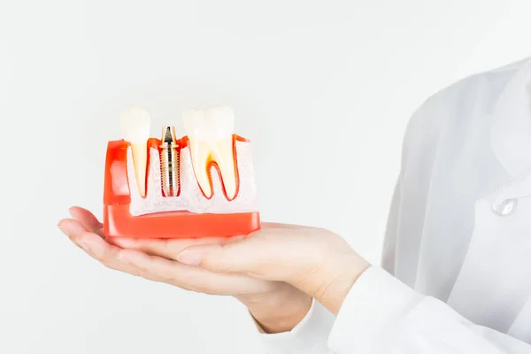 Dental implant dişeti içinde diş hekimi gösterisi modeli.
