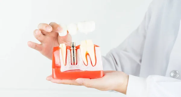 Dental implant dişeti içinde diş hekimi gösterisi modeli.