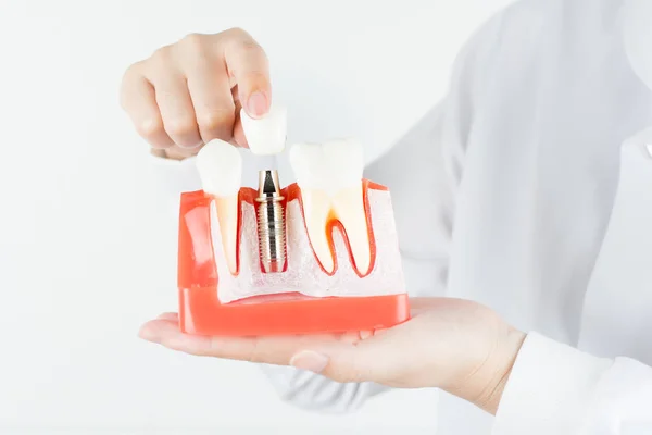Dental implant dişeti içinde diş hekimi gösterisi modeli.