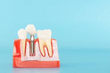 Mavi arka planda dental implant modeli ve beyaz seramik taç.