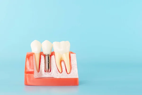 Mavi arka planda dental implant modeli.