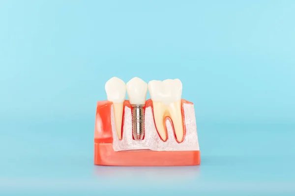 Modelo Implante Dental Sobre Fondo Azul — Foto de Stock