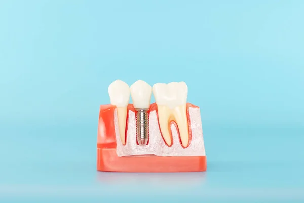 Mavi arka planda dental implant modeli.
