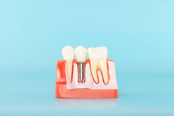 Dental implant model on blue background.