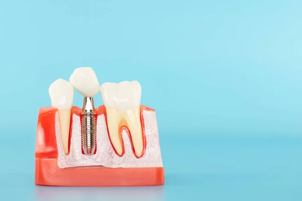 Modelo Implante Dentário Coroa Cerâmica Branca Sobre Fundo Azul — Fotografia de Stock