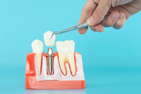 Mavi arka planda dental implant modeli ve beyaz seramik taç.