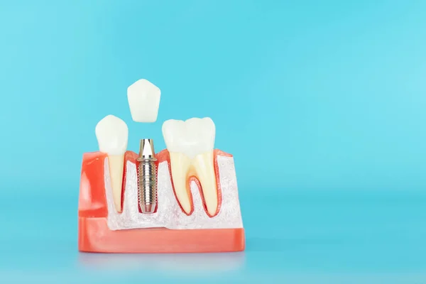Mavi arka planda beyaz seramik taçlı dental implant modeli.