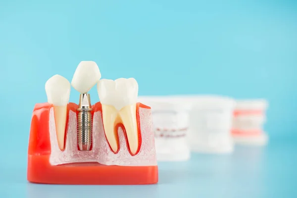 Arka planda diğer diş modeli ile dental implant modeli.