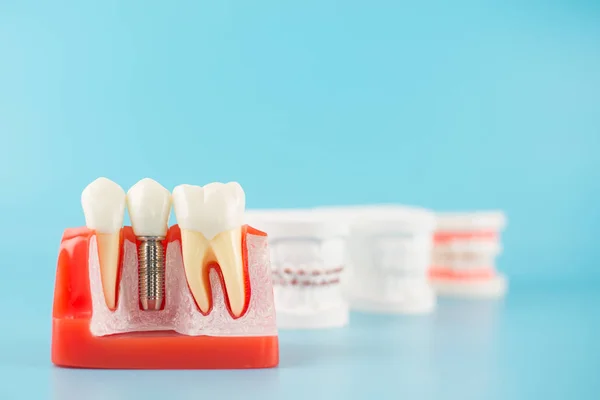 Dental implant model with other dental model on background.