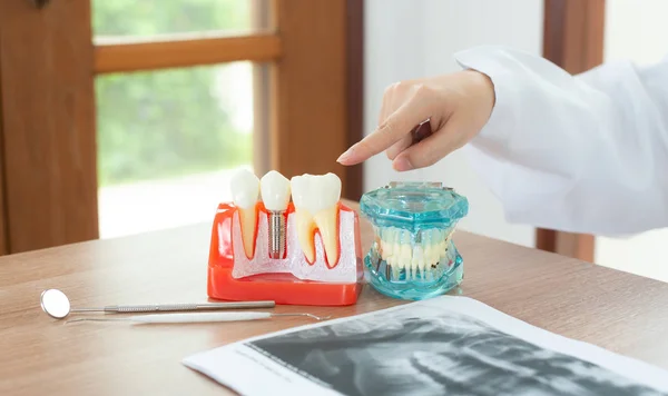 Diş implantı modeli ile diş hekimi.