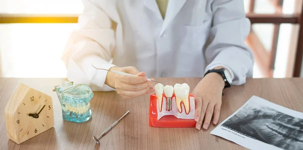 Diş bakımı konseptinde implant diş modeli.