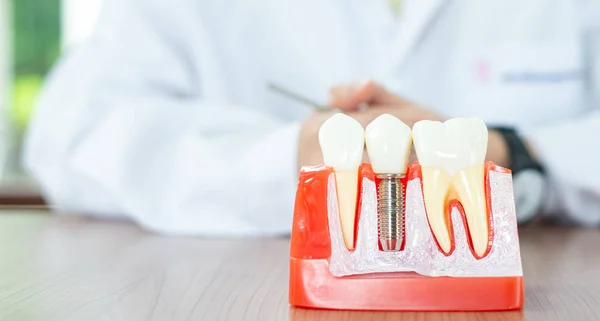 Diş bakımı konseptinde implant diş modeli.