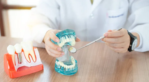 Implantat- dentalmodell i tannpleiebegrepet . – stockfoto