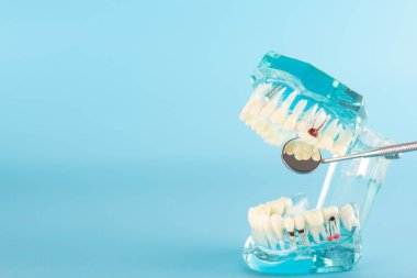 Mavi arka planda dental implant modeli.