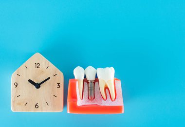 Mavi arka plan üzerinde dental implant modeli ile ahşap saat.