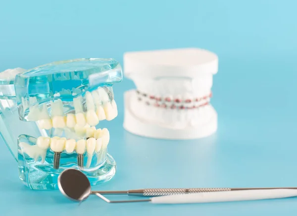 Dental implant model on blue background.