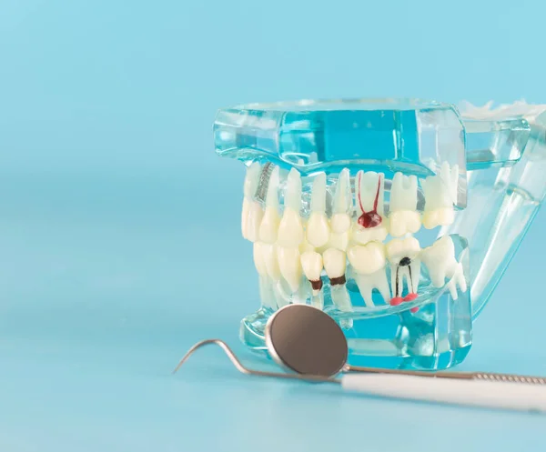 Modelo de implante dentário em fundo azul . — Fotografia de Stock