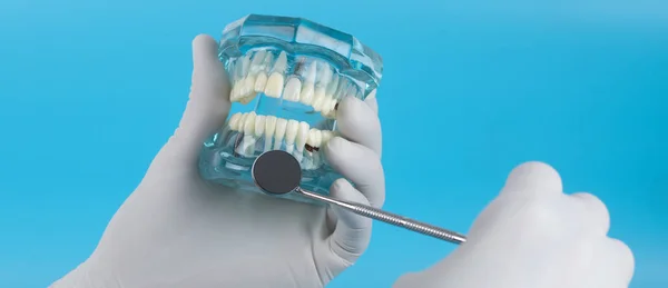 The dentist held a dental planned model to show the samples to patients.