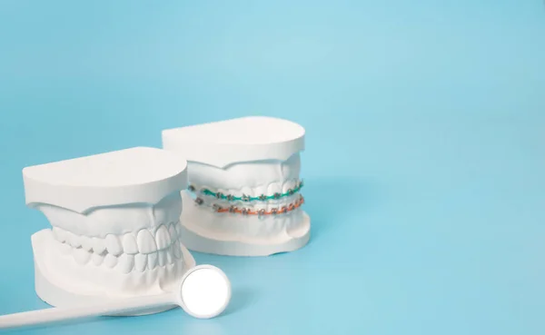Ejemplos Modelos Dentales Modelos Ortodoncia Hechos Yeso Blanco Adjuntar Aparatos — Foto de Stock