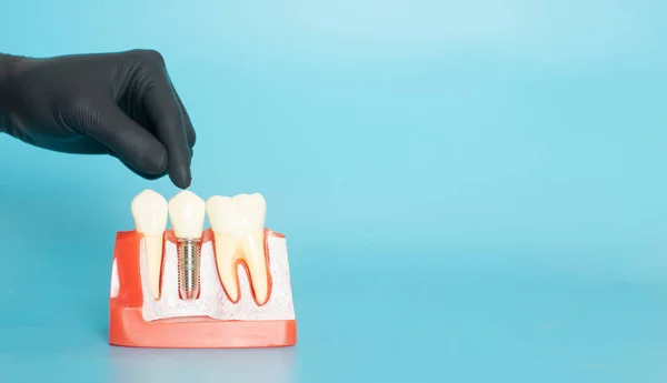 Examples of dental models and orthodontic models made of white plaster. Attach braces And the hands of the dentist Constituted To show an example to patients with braces or dentures before starting dental treatment. On a blue background and copy spac