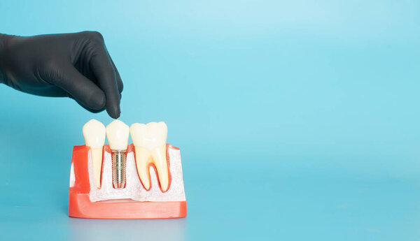 Examples of dental models and orthodontic models made of white plaster. Attach braces And the hands of the dentist Constituted To show an example to patients with braces or dentures before starting dental treatment. On a blue background and copy spac