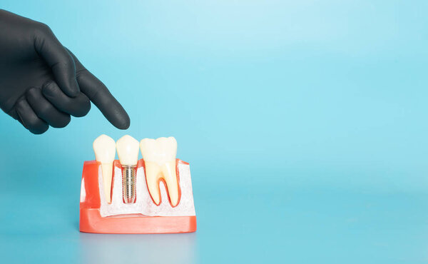 Examples of dental models and orthodontic models made of white plaster. Attach braces And the hands of the dentist Constituted To show an example to patients with braces or dentures before starting dental treatment. On a blue background and copy spac