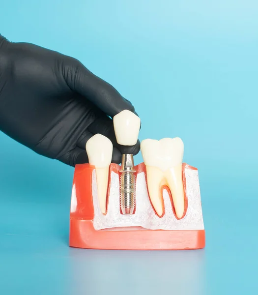 Приклади Стоматологічних Моделей Ортодонтичних Моделей Білої Штукатурки Прикріпіть Брекети Руки Стокове Зображення