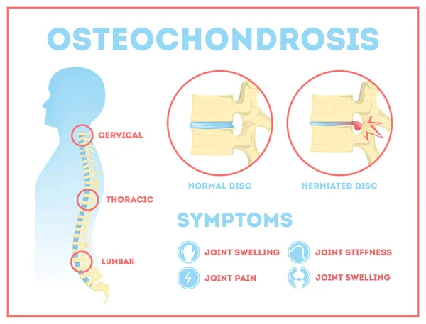 Osteochondrosis anatomical infographic. Lumbar, cervical and thoracic — Stock Illustration Osteochondrosis anatomical infographic. Lumbar, cervical and thoracic Vector Graphics