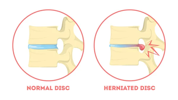Disc degeneration. Human anatomy. Spine problem. Healthy — Stock Illustration Disc degeneration. Human anatomy. Spine problem. Healthy Royalty Free Stock Vectors