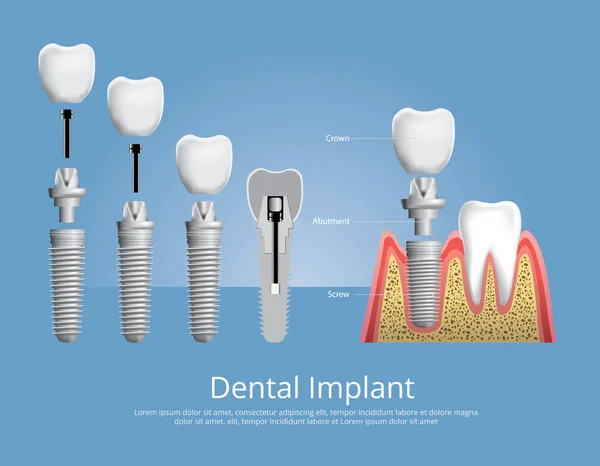Dientes Humanos Implante Dental Vector Illustration — Archivo Imágenes Vectoriales