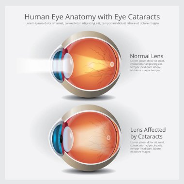İnsan gözünün anatomisi ve Normal Lens vektör çizim