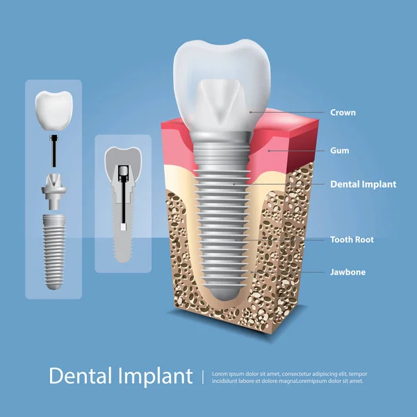 Dientes Humanos Implante Dental Vector Illustration — Vector de stock