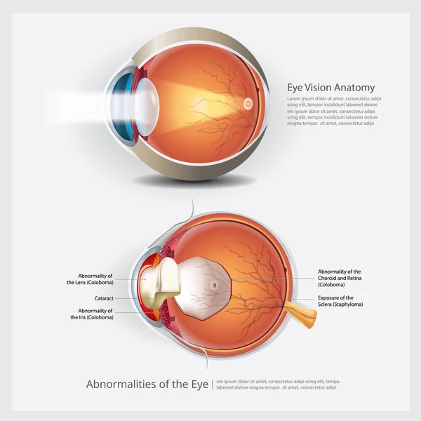 Anatomie Oculaire Avec Anomalies Oculaires Illustration Vectorielle — Image vectorielle