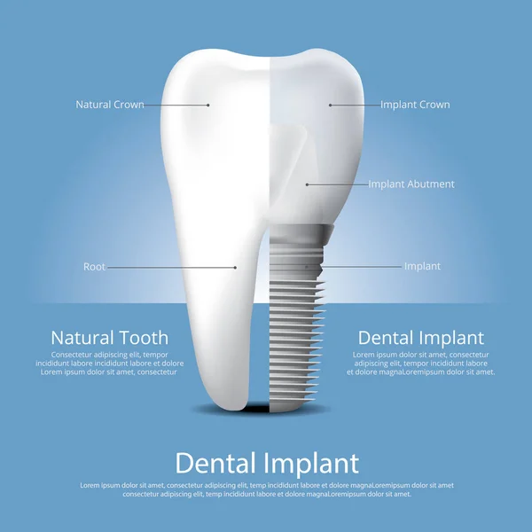 Dientes Humanos Implante Dental Vector Illustration — Archivo Imágenes Vectoriales