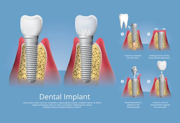 Dientes Humanos Implante Dental Vector Illustration — Vector de stock