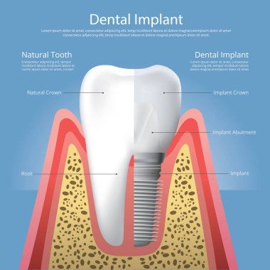İnsan dişleri ve diş implantı Vektör İllüstrasyonu