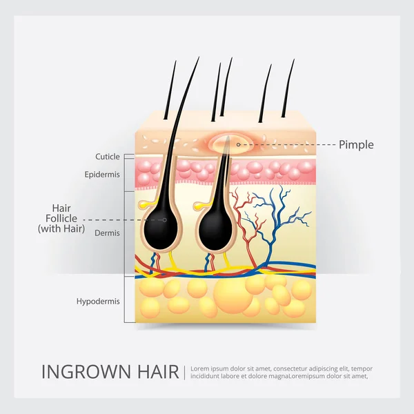 Saç Kaybı Yapısı Vektörü Llüstrasyonu — Stok Vektör