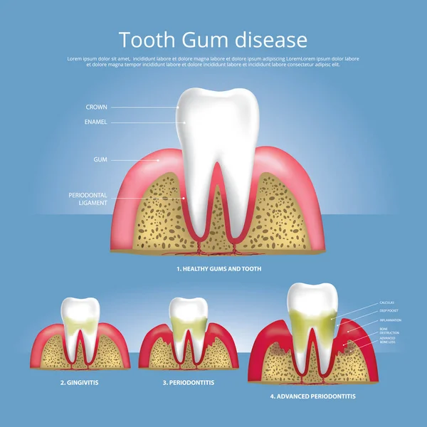 Зуби Людини Етапи Захворювання Ясен Векторні Ілюстрації — стоковий вектор