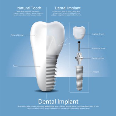 İnsan dişleri ve diş implantı Vektör İllüstrasyonu