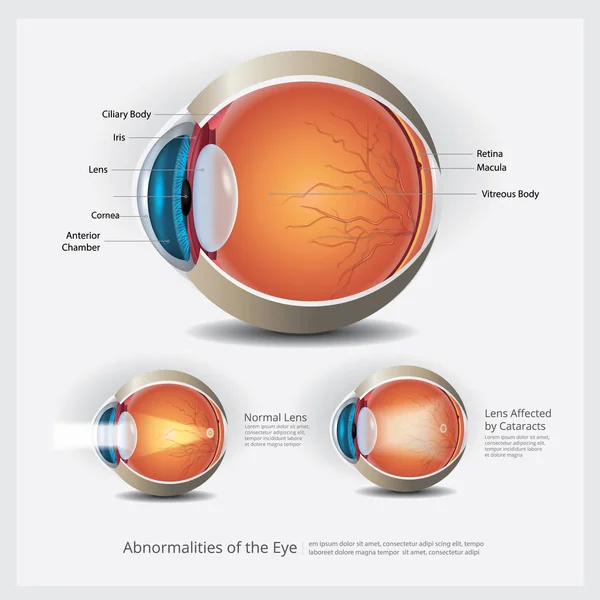 Augenanatomie Mit Augenanomalien Vektorillustration — Stockvektor