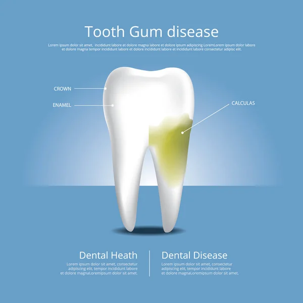 Human Teeth Stages Gum Disease Vector Illustration — Stock Vector