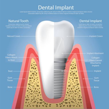 İnsan dişleri ve diş implantı Vektör İllüstrasyonu