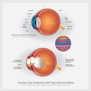 Göz anatomisi göz anormallikleri vektör çizim ile
