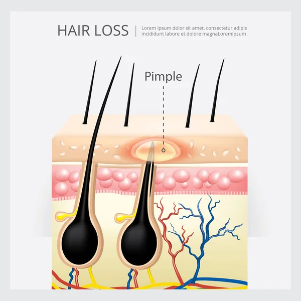 Haarausfall Struktur Vektor Illustration — Stockvektor